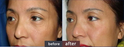 开眼角手术后遗症