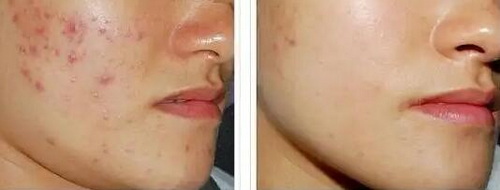 面部皮肤松弛毛孔粗大