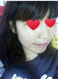 颧骨、下巴和额头都做了,终于敢尽情地自拍了!