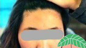 颧骨、下巴和额头都做了,终于敢尽情地自拍了!