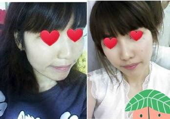 颧骨、下巴和额头都做了,终于敢尽情地自拍了!