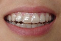 龅牙矫正的方法有哪些?龅