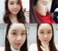 丰额头注射好还是假体好?