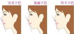 垫下巴选择哪种材料好?哪