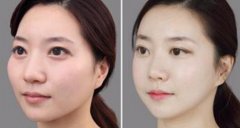 颧骨整形会不会有风险?需