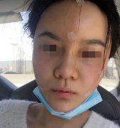 自体脂肪丰面颊效果好不好