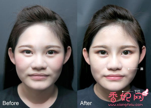 【玻尿酸山根+下巴】微整形案例,鼻+下巴通通挺身而出了