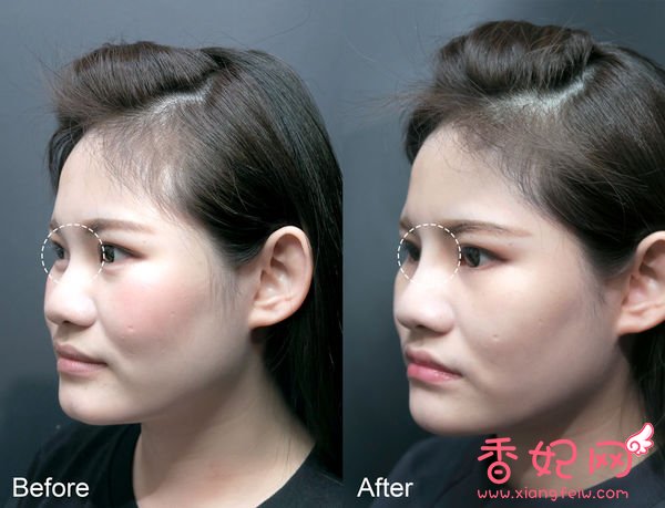 【玻尿酸山根+下巴】微整形案例,鼻+下巴通通挺身而出了