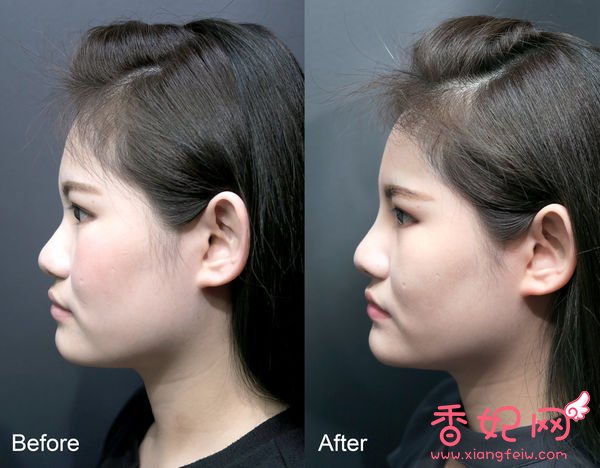 【玻尿酸山根+下巴】微整形案例,鼻+下巴通通挺身而出了