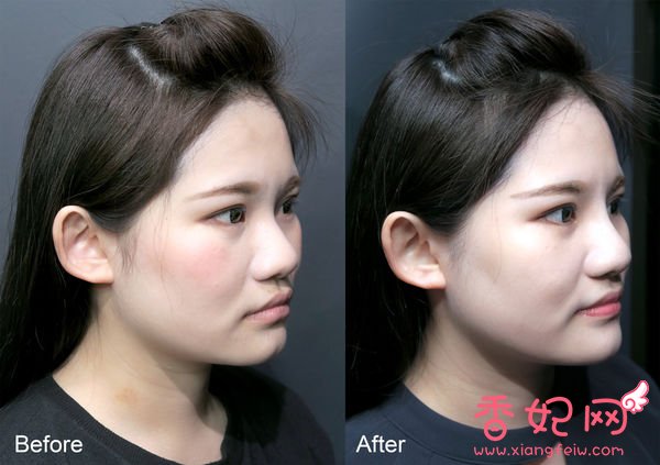 【玻尿酸山根+下巴】微整形案例,鼻+下巴通通挺身而出了