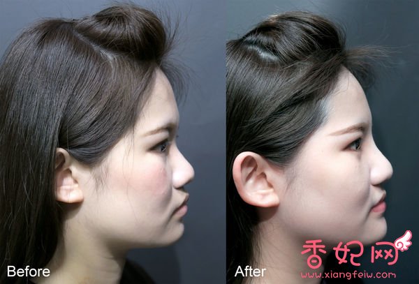 【玻尿酸山根+下巴】微整形案例,鼻+下巴通通挺身而出了