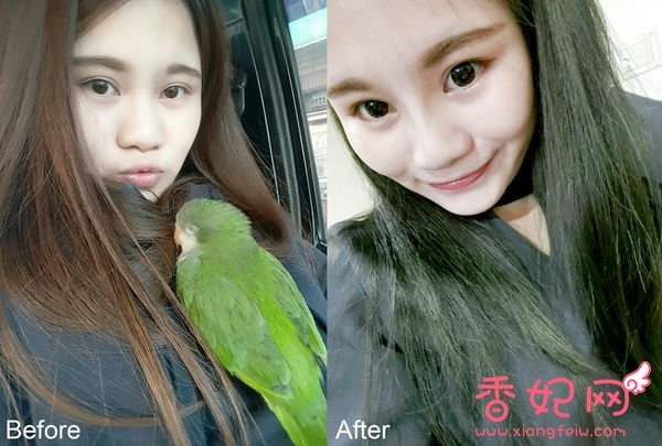 【玻尿酸山根+下巴】微整形案例,鼻+下巴通通挺身而出了