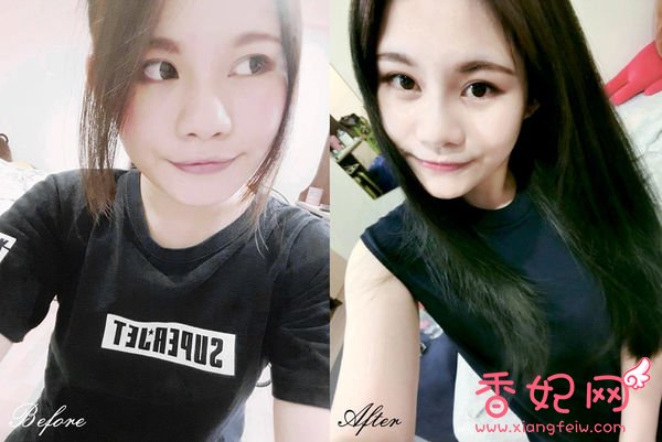 【玻尿酸山根+下巴】微整形案例,鼻+下巴通通挺身而出了