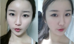 玻尿酸丰太阳穴能保持多久