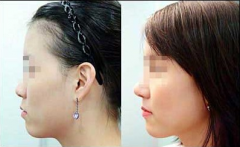 快速瘦脸的方法有哪些呢?