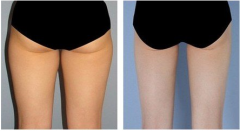 吸脂减肥手术对年龄有要求