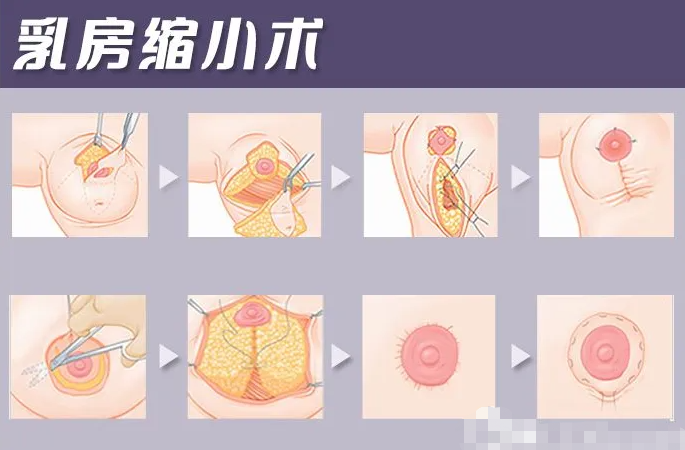 多大可以做乳房缩小手术，哪些情况适合做乳房缩小手术?