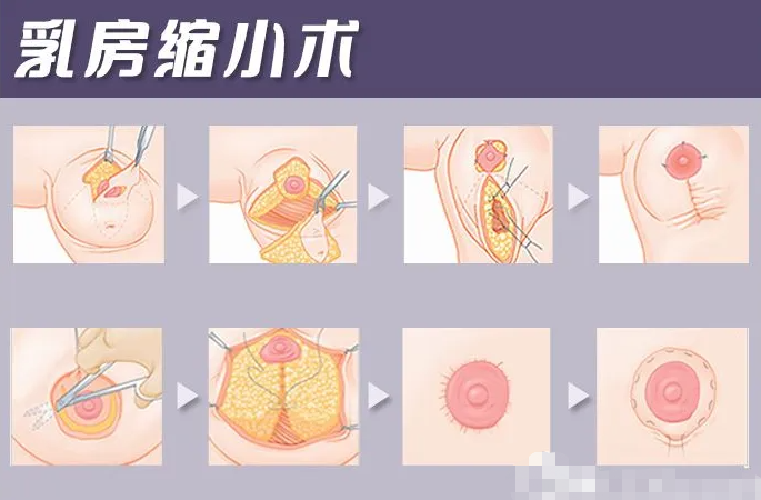 多大可以做乳房缩小手术,哪些情况适合做乳房缩小手术?