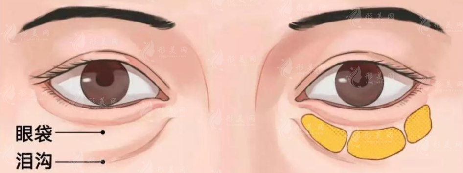 不开刀去眼袋费用高不高? 不开刀去眼袋费用高不高?