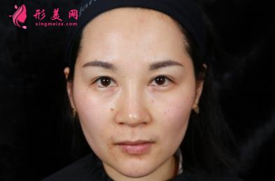 四川华西医院整形科玻尿酸丰太阳穴案例查询!含2022全新价格表公 四川华西医院整形科玻尿酸丰太阳穴案例查询!含2022全新价格表公