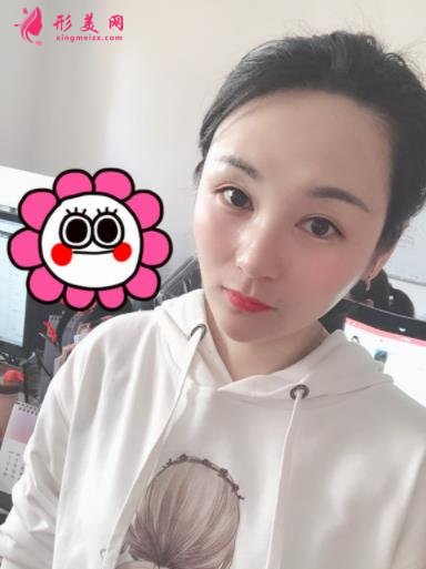 四川华西医院整形科玻尿酸丰太阳穴案例查询!含2022全新价格表公 四川华西医院整形科玻尿酸丰太阳穴案例查询!含2022全新价格表公