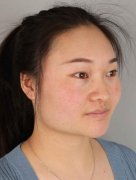 西安国际医学中心整形医院怎么样?下颌角案例及价格表一览