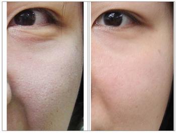 彩光嫩肤的危害有哪些