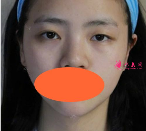 西安西京刘超华做双眼皮怎么样?40天恢复效果真的很棒