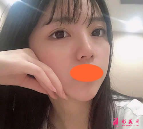 西安西京刘超华做双眼皮怎么样?40天恢复效果真的很棒