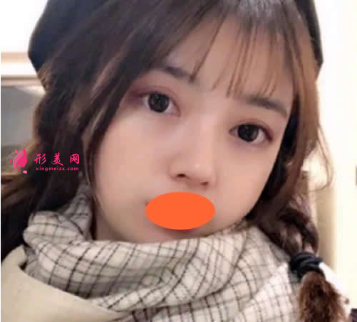 西安西京刘超华做双眼皮怎么样?40天恢复效果真的很棒