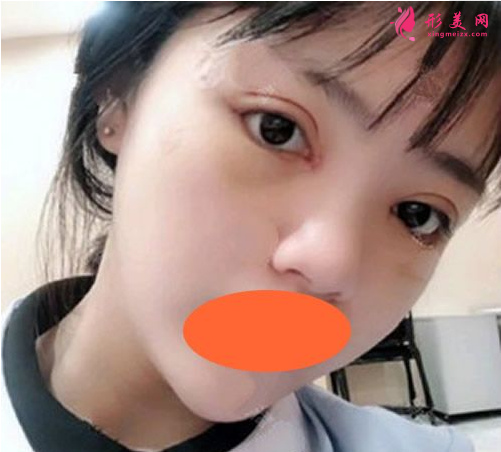 西安西京刘超华做双眼皮怎么样?40天恢复效果真的很棒