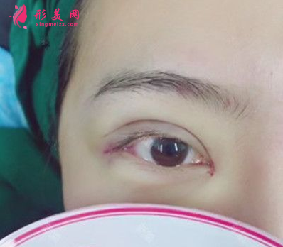 西安西京刘超华做双眼皮怎么样?40天恢复效果真的很棒