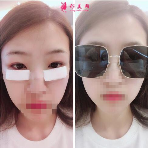 2020!深圳名媛汇整形医疗美容价格表,外切去眼袋体验分享