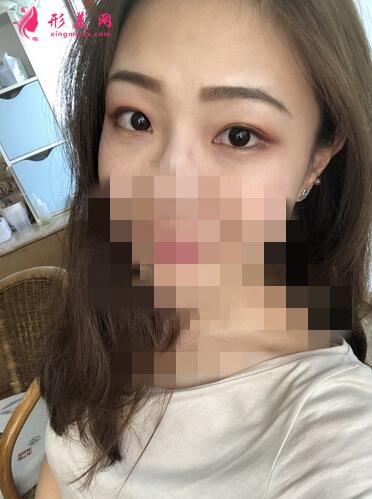 2020!深圳名媛汇整形医疗美容价格表,外切去眼袋体验分享