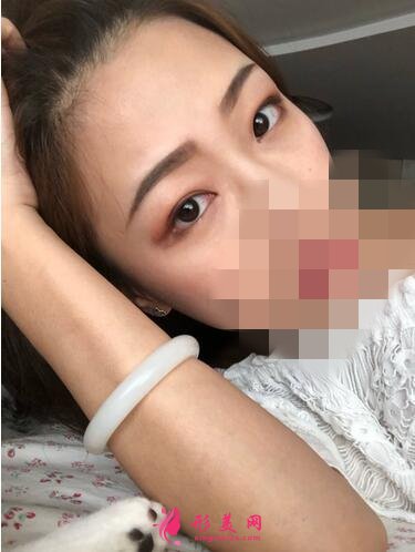 2020!深圳名媛汇整形医疗美容价格表,外切去眼袋体验分享