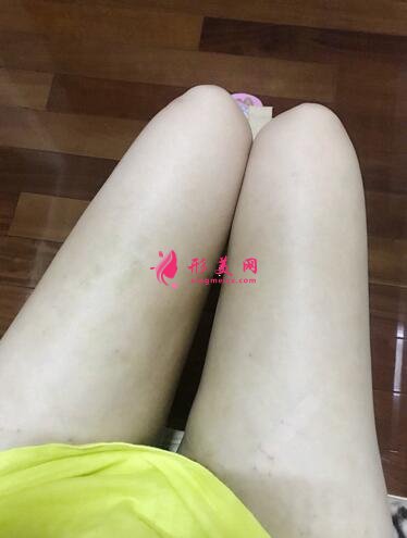 北京自体脂肪隆胸术案例,术后4个月恢复过程!