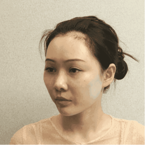 北京八大处磨骨多少钱?2022价格表曝光+磨骨案例 北京八大处磨骨多少钱?2022价格表曝光+磨骨案例