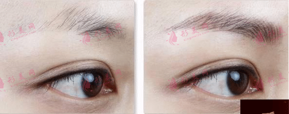 眉毛移植费用多少钱?眉毛移植效果怎么样?