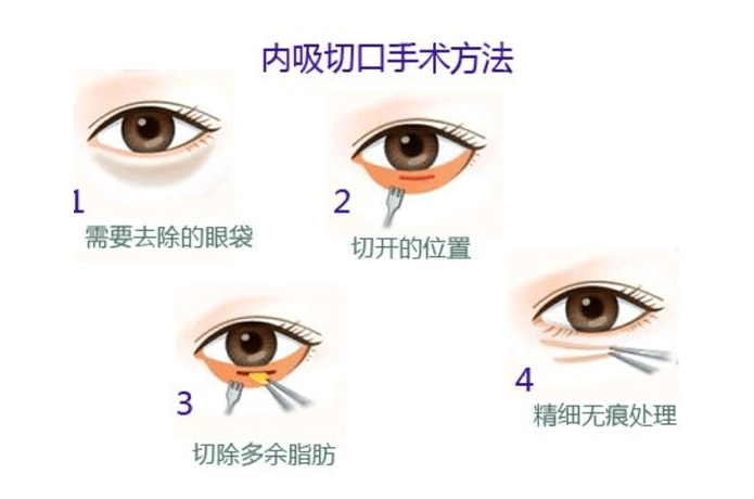 内切祛眼袋是永久的吗?会复发吗?