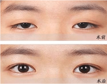 眼睑下垂的种类有哪些?矫正方法及注意事项分享