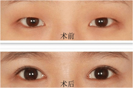 眼部整形 眼部整形