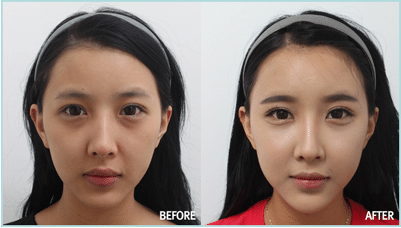 卧蚕整形 卧蚕整形