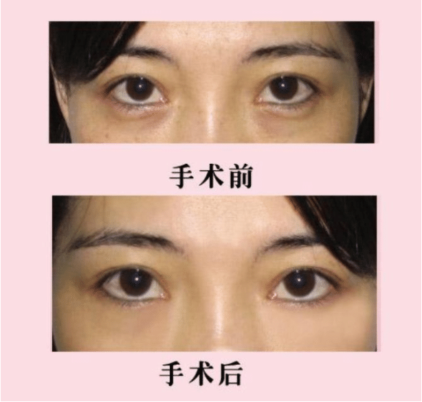提眉术前后对比 提眉术前后对比