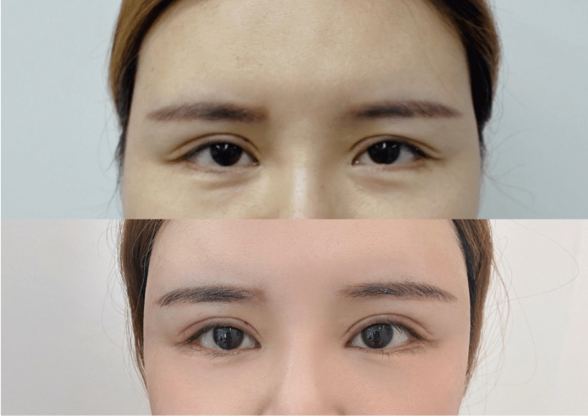 双眼皮修复前后对比 双眼皮修复前后对比