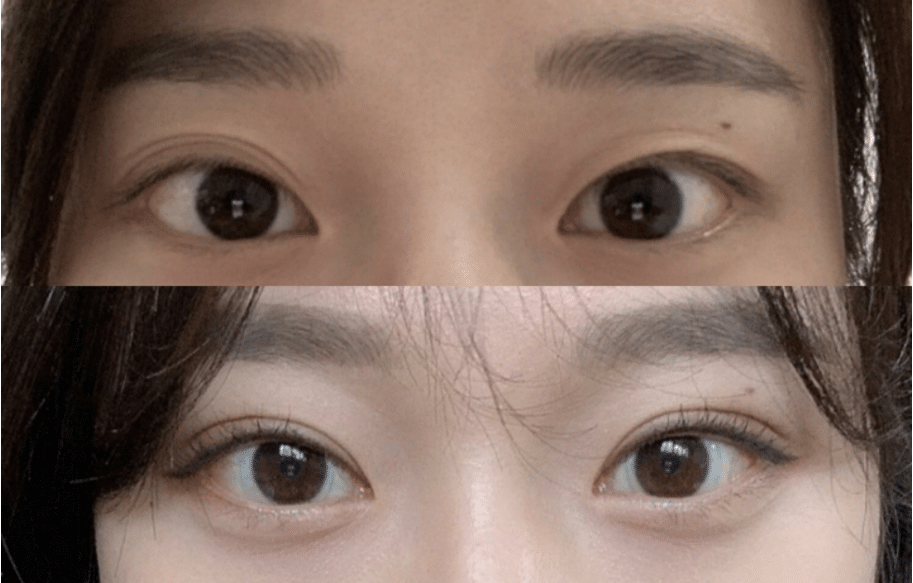 双眼皮修复前后对比 双眼皮修复前后对比