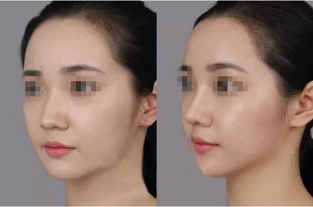 隆鼻术后对比 隆鼻术后对比