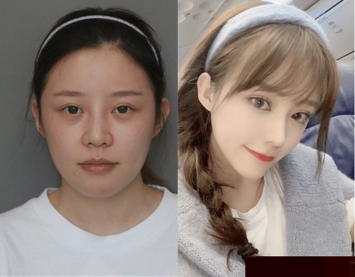 隆鼻案例 隆鼻案例