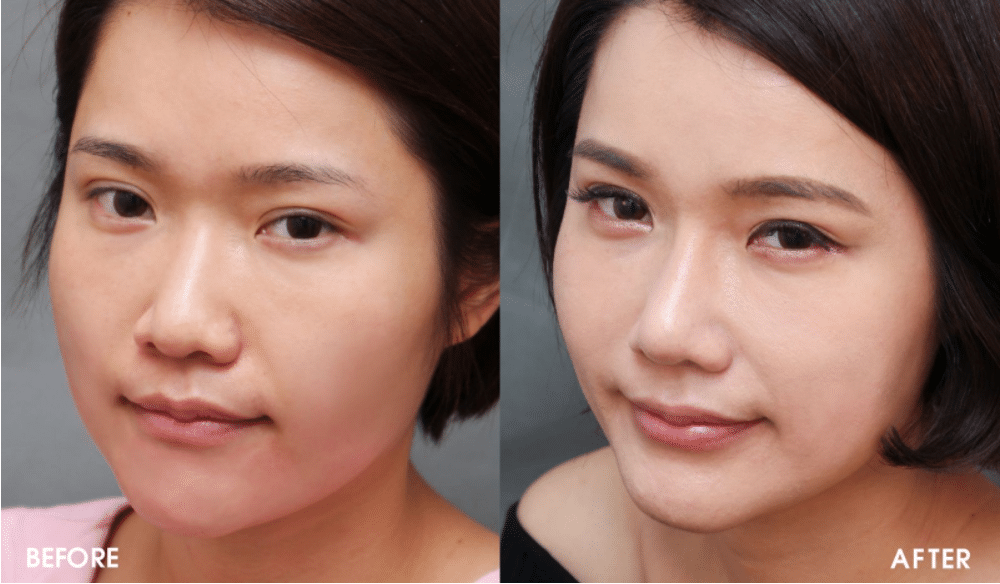 隆鼻术后对比 隆鼻术后对比