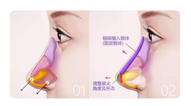 隆鼻手术 隆鼻手术