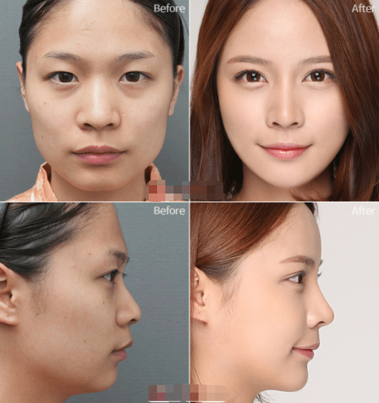 鼻翼缩小 鼻翼缩小